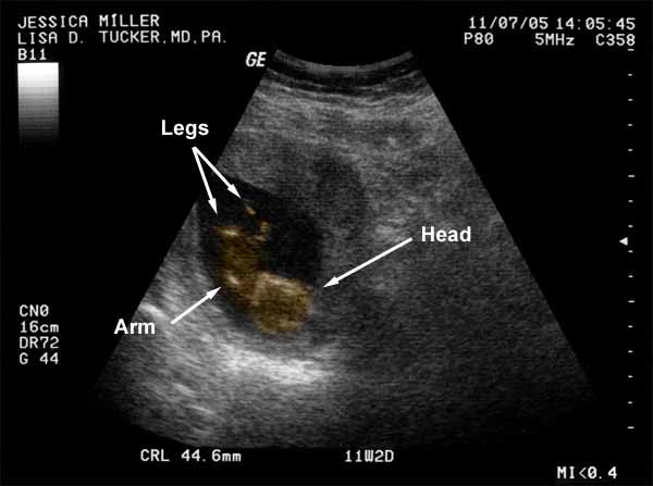 Here is the baby laying upside down (on his/her head). You can see the left arm and the two legs.